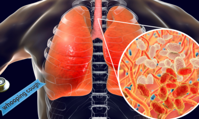 Understanding Pertussis Outbreaks: How to Stay Protected