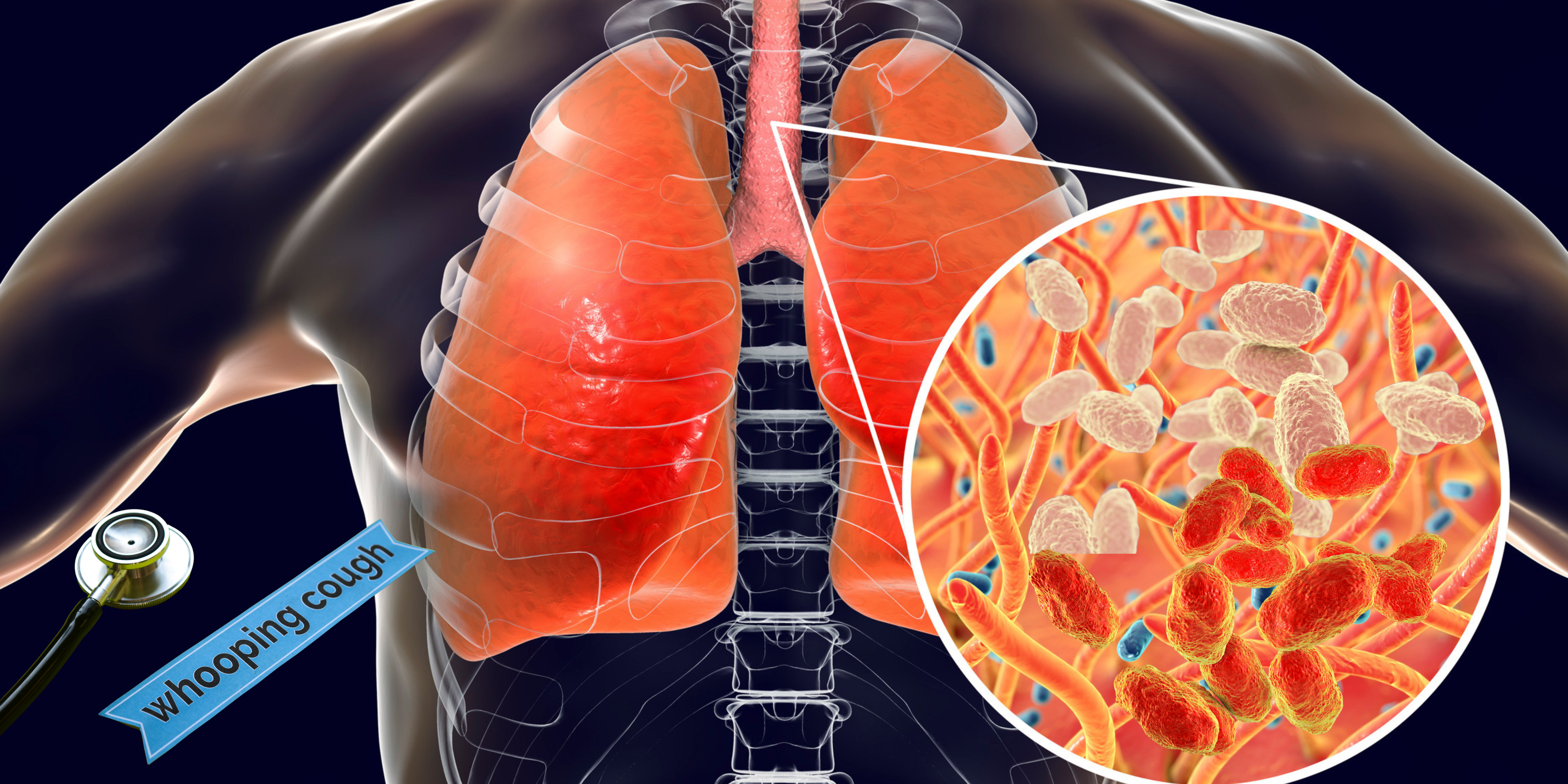 Understanding Pertussis Outbreaks: How to Stay Protected